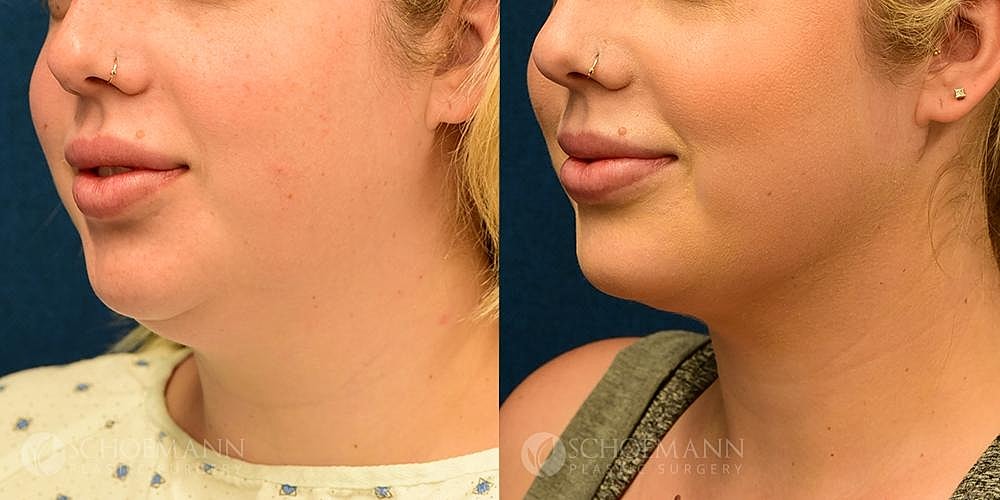 Neck Lift Before & After