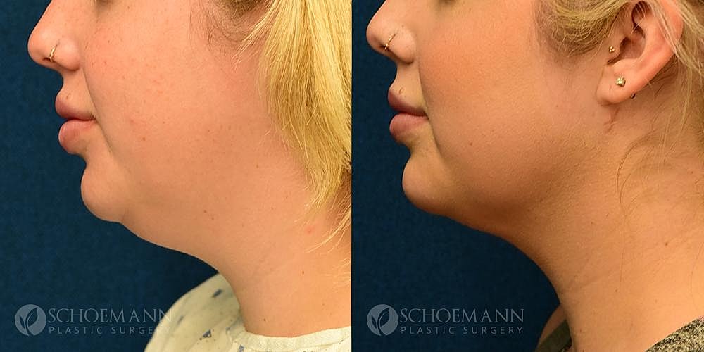 Neck Lift Before & After