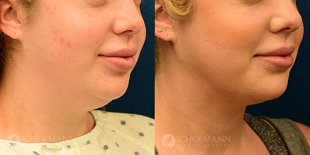 Neck Lift Before & After