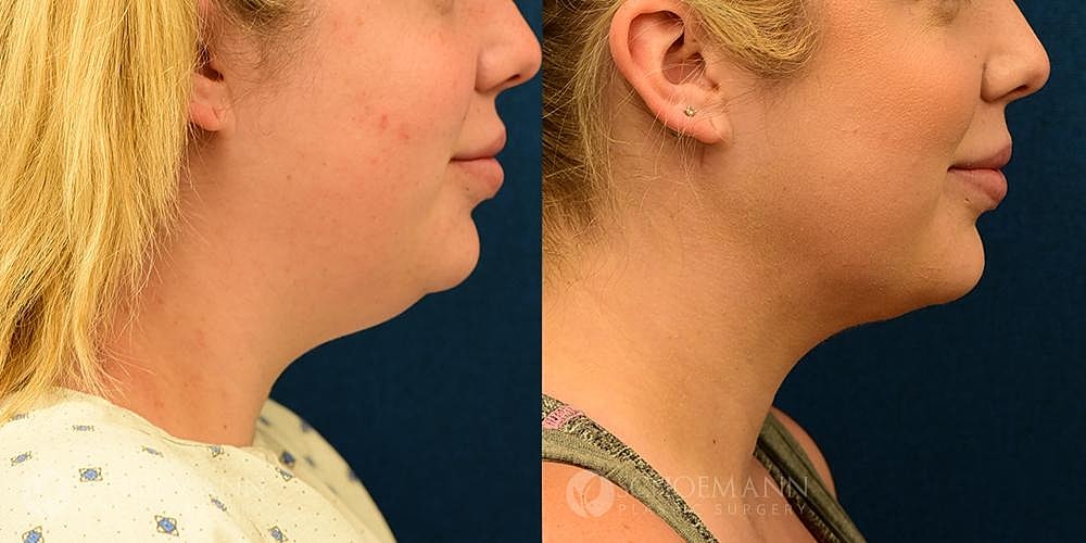 Neck Lift Before & After