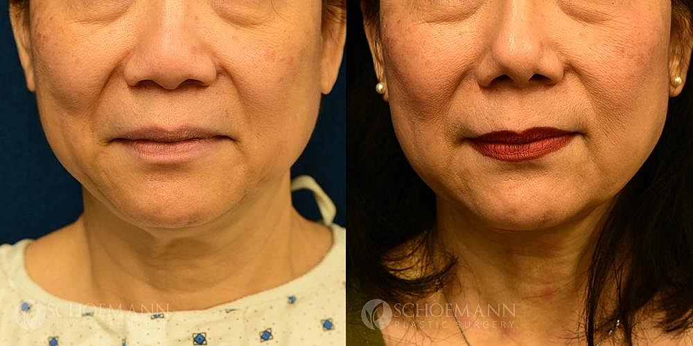 Neck Lift Before & After