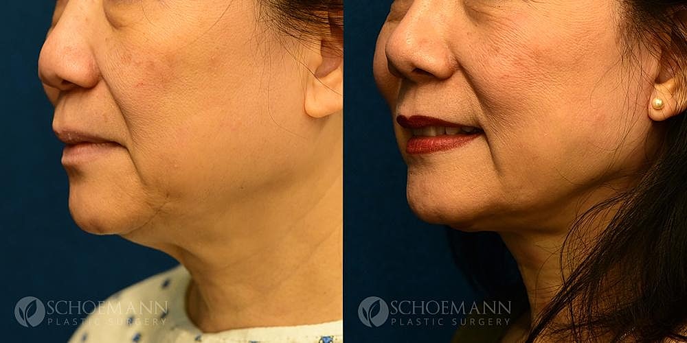Neck Lift Before & After