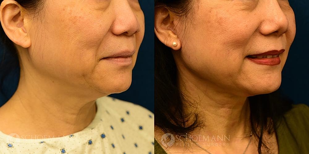 Neck Lift Before & After