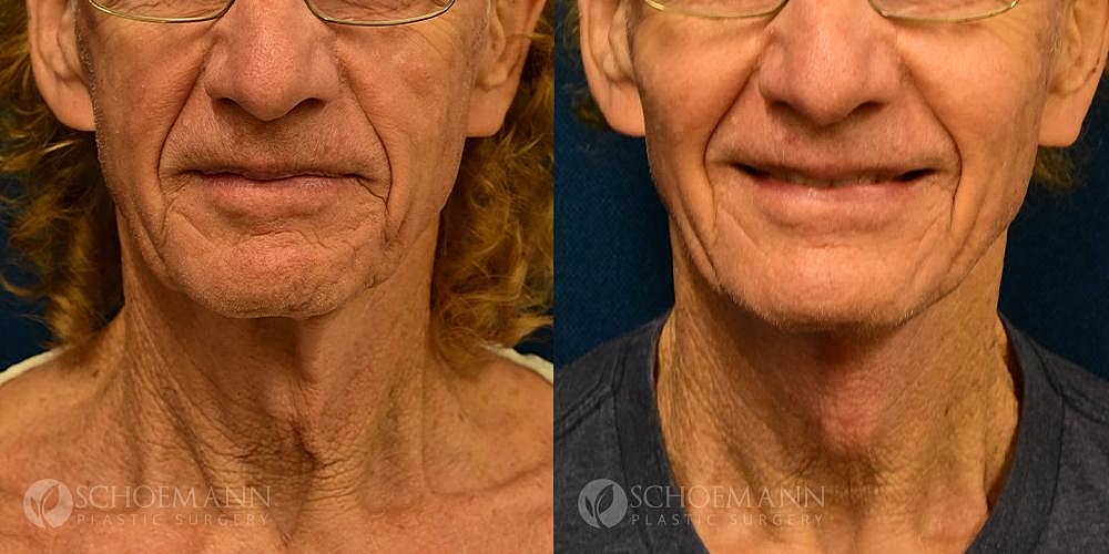 Neck Lift Before & After