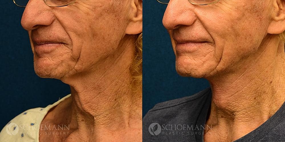 Neck Lift Before & After