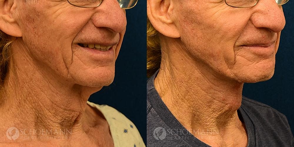 Neck Lift Before & After