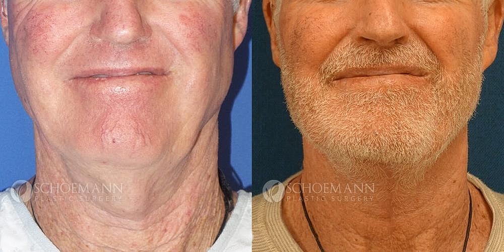 Neck Lift Before & After