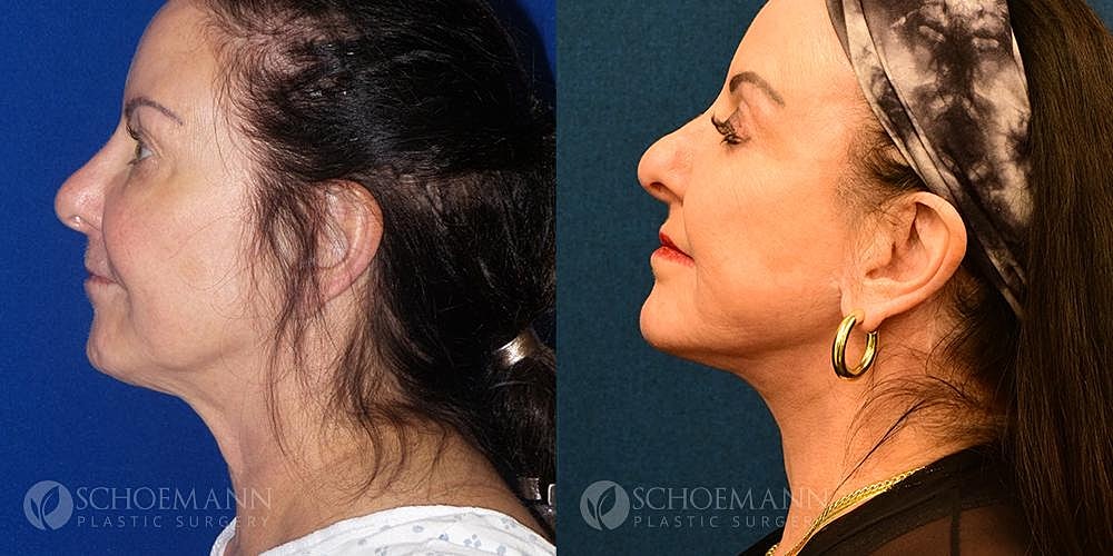 Neck Lift Before & After