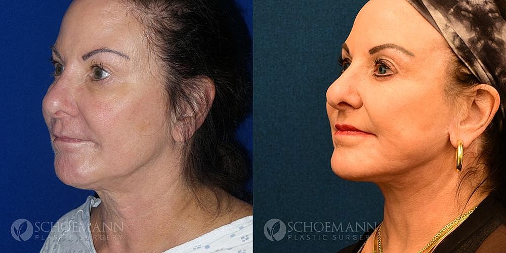 Neck Lift Before & After