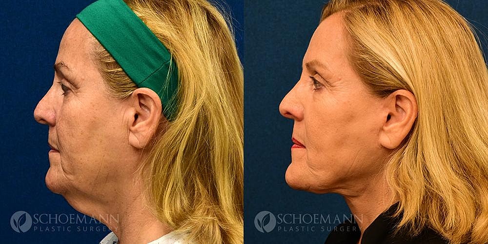 Neck Lift Before & After