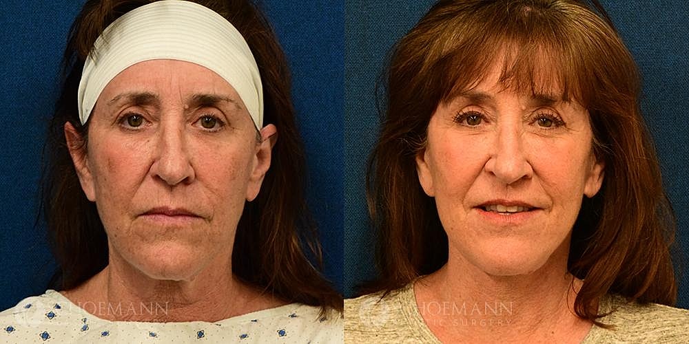 Neck Lift Before & After