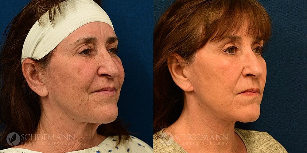 Neck Lift Before & After