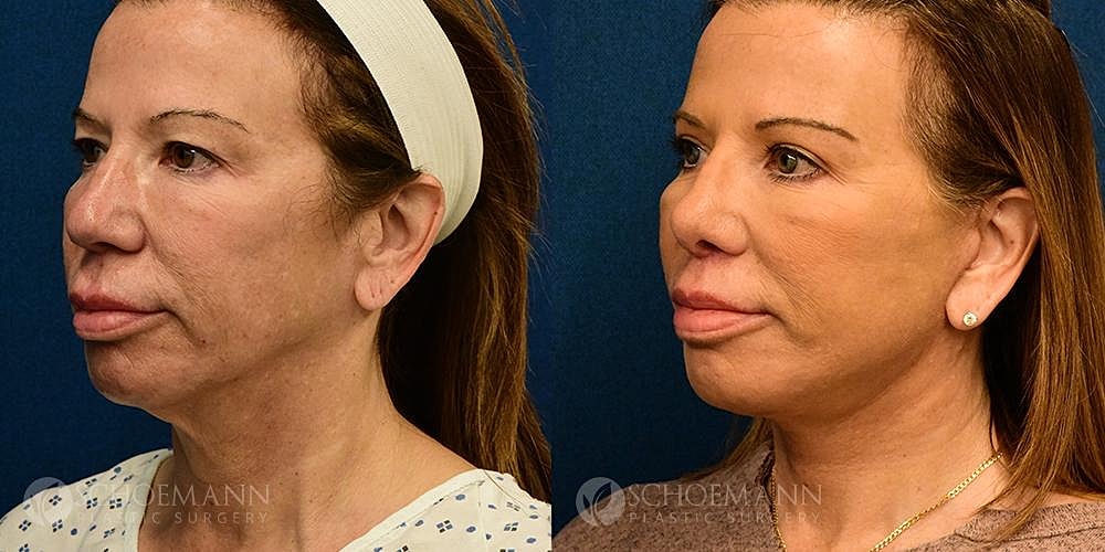 Neck Lift Before & After