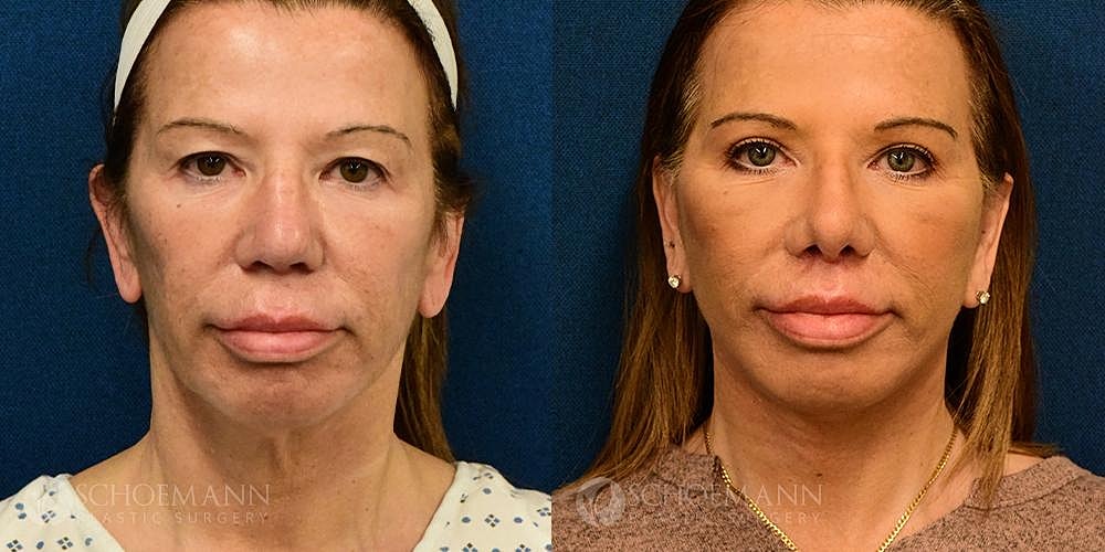 Neck Lift Before & After