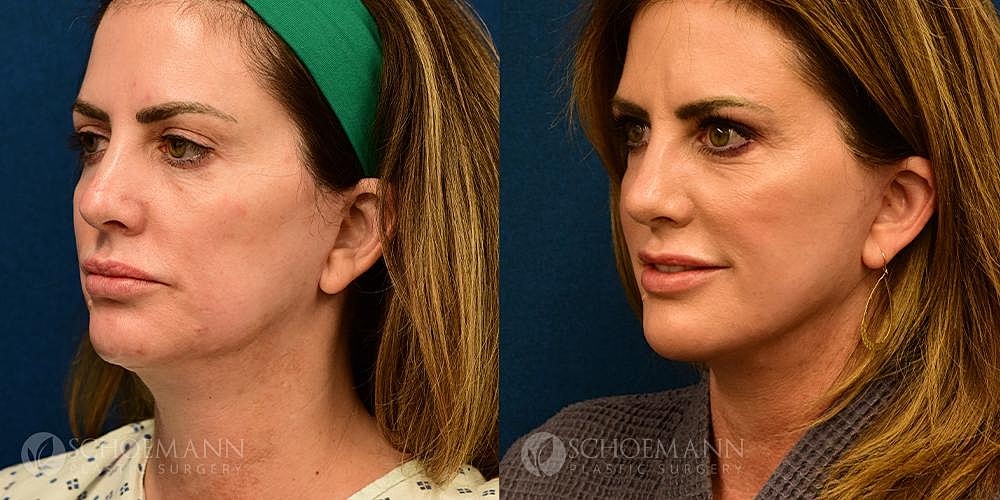 Neck Lift Before & After