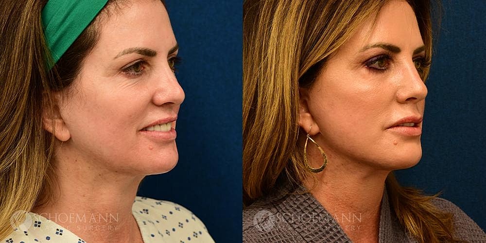 Neck Lift Before & After