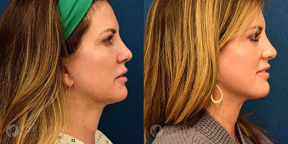 Neck Lift Before & After