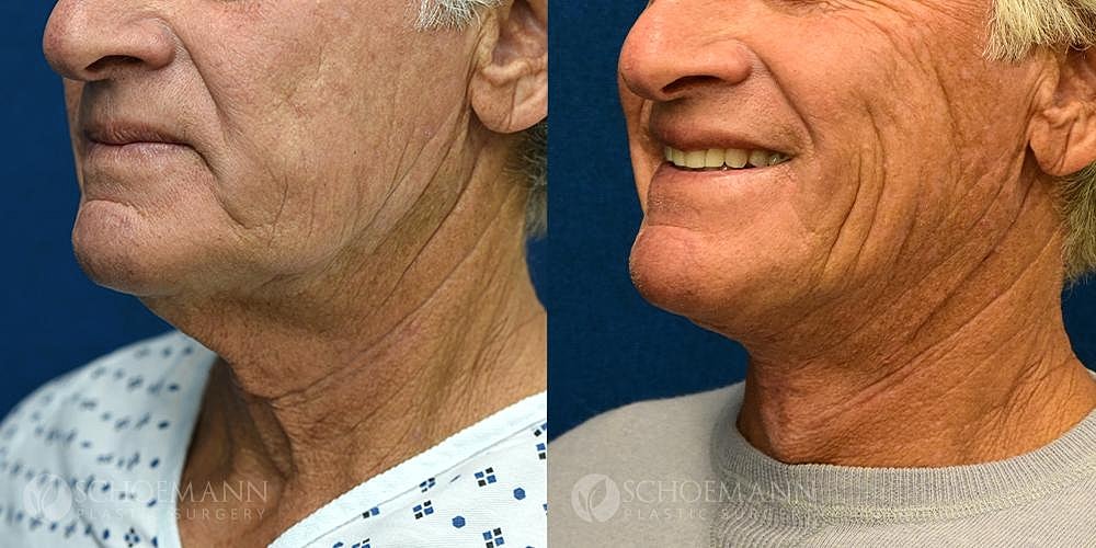 Neck Lift Before & After