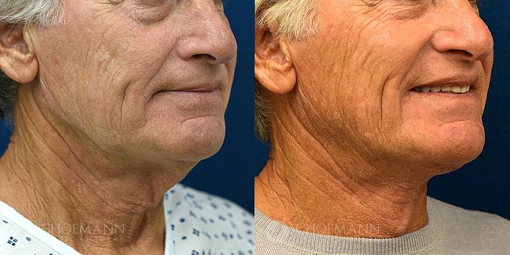 Neck Lift Before & After