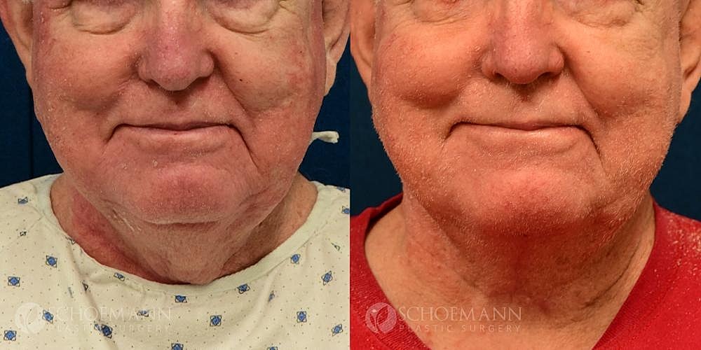Neck Lift Before & After