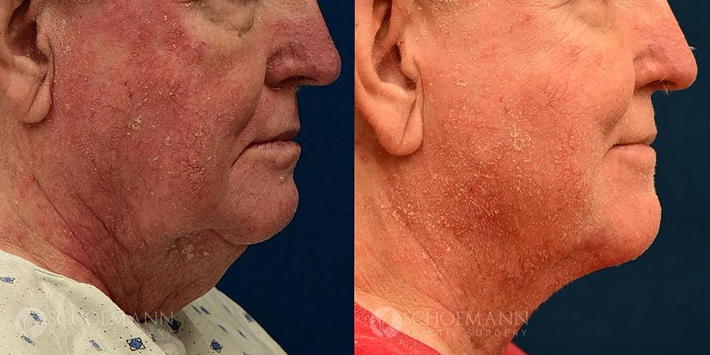 Neck Lift Before & After