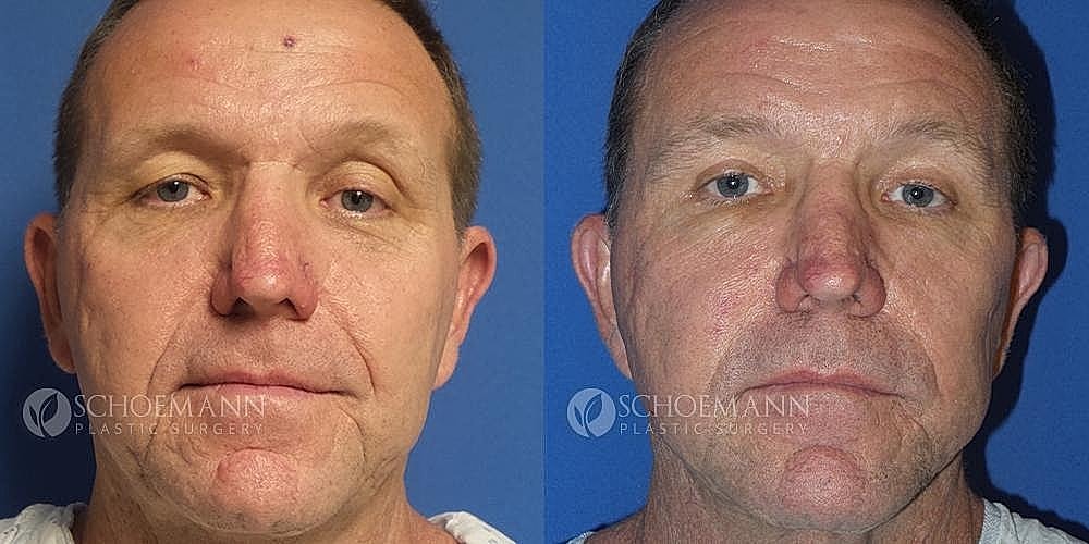 Facelift Before & After
