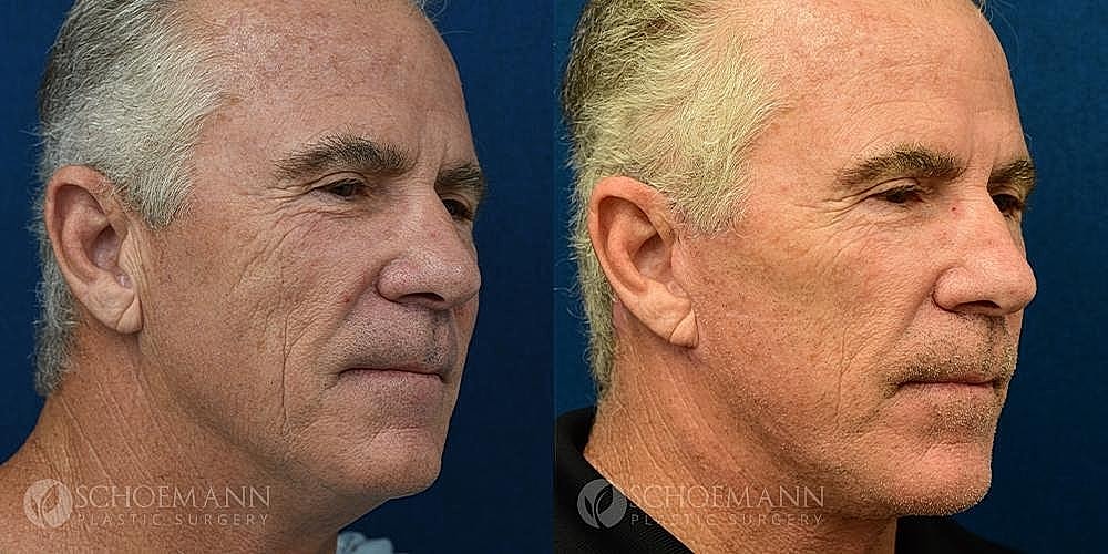 Facelift Before & After