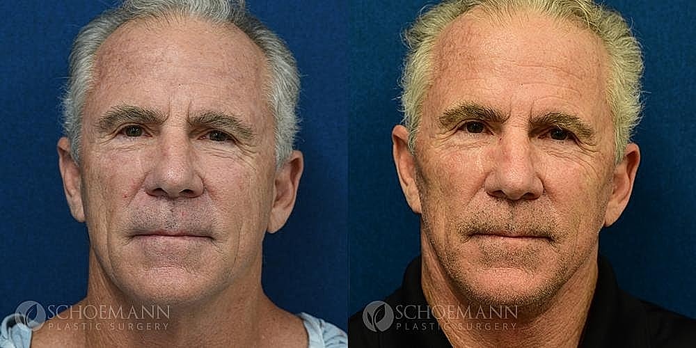 Facelift Before & After