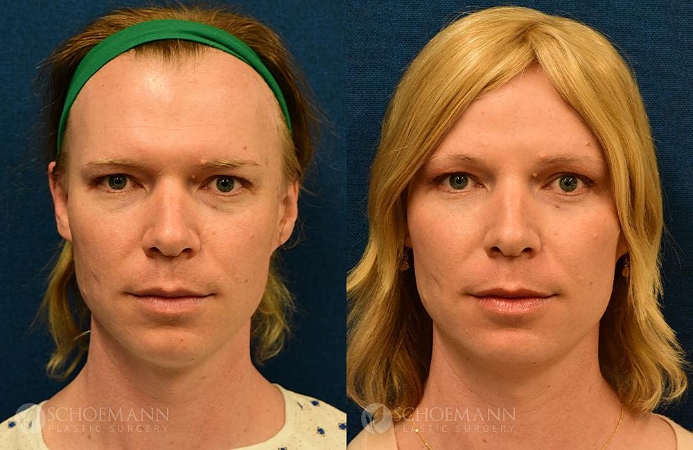 Facial Feminization Surgery Ffs Before & After