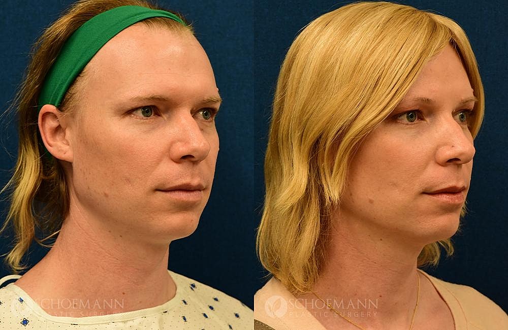 Facial Feminization Surgery Ffs Before & After