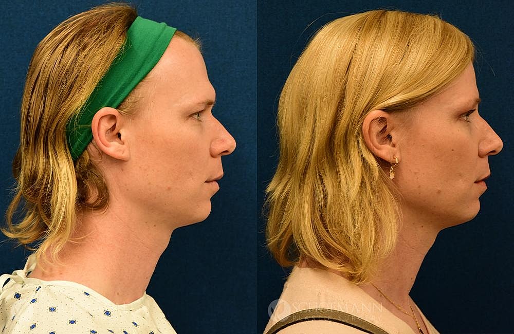 Facial Feminization Surgery Ffs Before & After