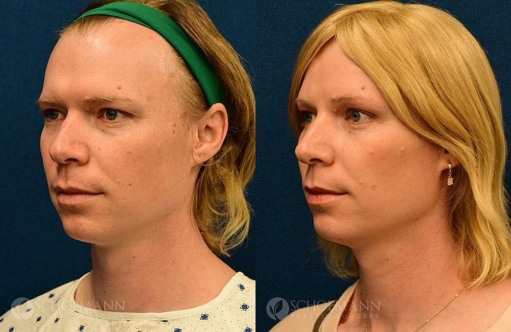 Facial Feminization Surgery Ffs Before & After
