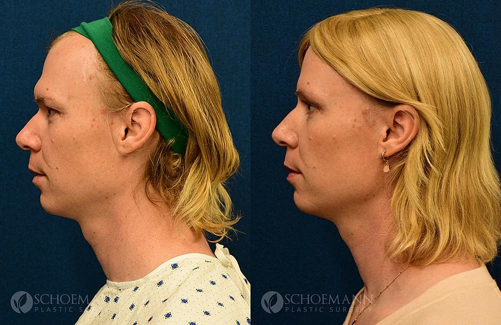 Facial Feminization Surgery Ffs Before & After