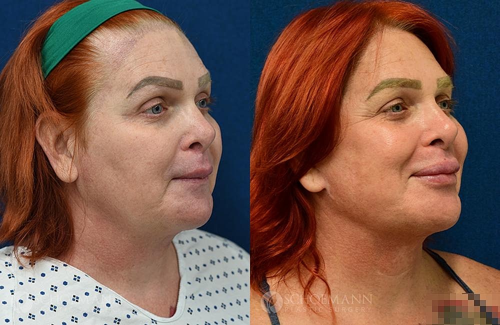 Facial Feminization Surgery Ffs Before & After