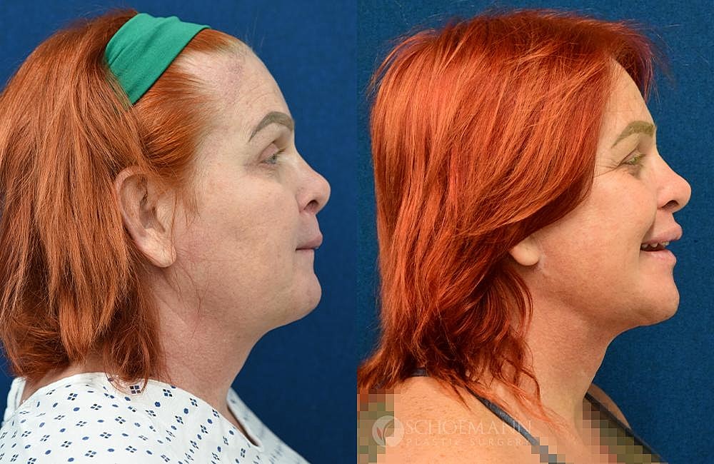 Facial Feminization Surgery Ffs Before & After
