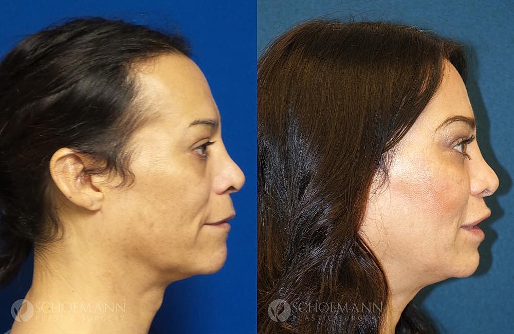 Facial Feminization Surgery Ffs Before & After