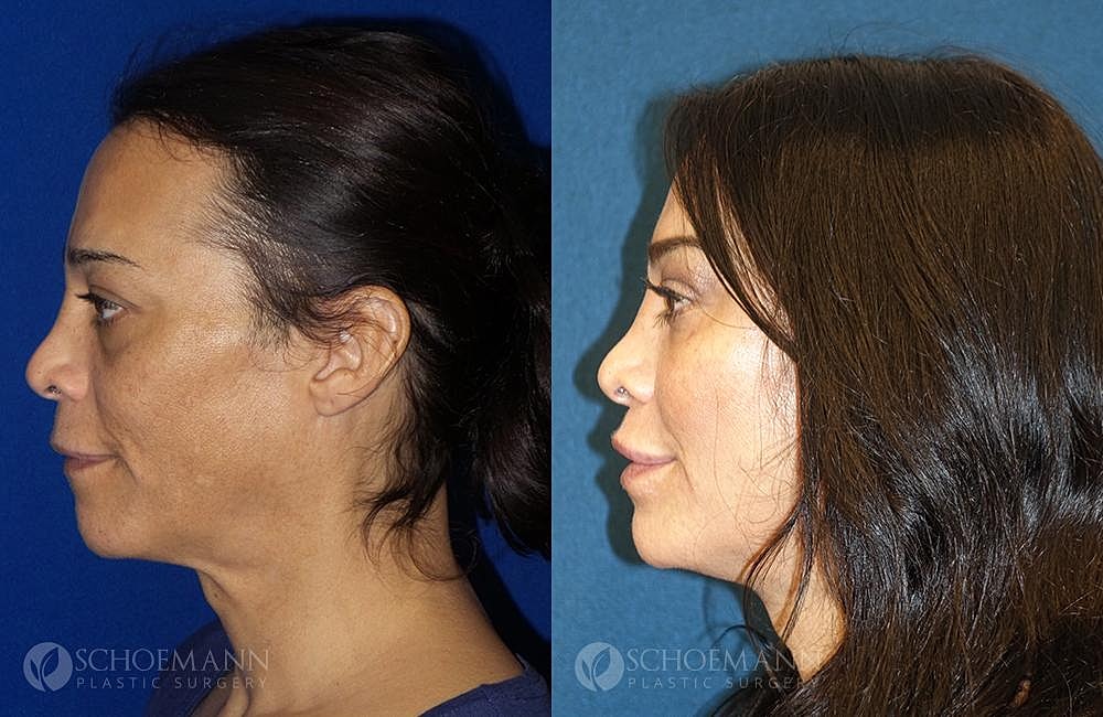 Facial Feminization Surgery Ffs Before & After