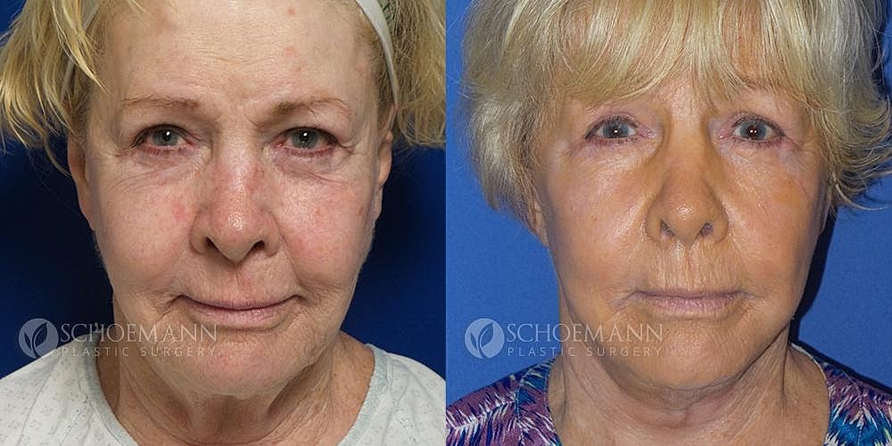Facelift Before & After