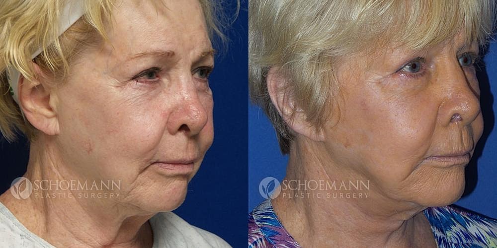 Facelift Before & After