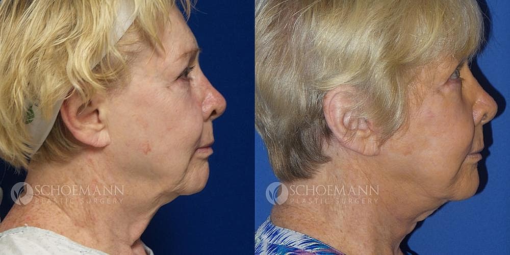 Facelift Before & After