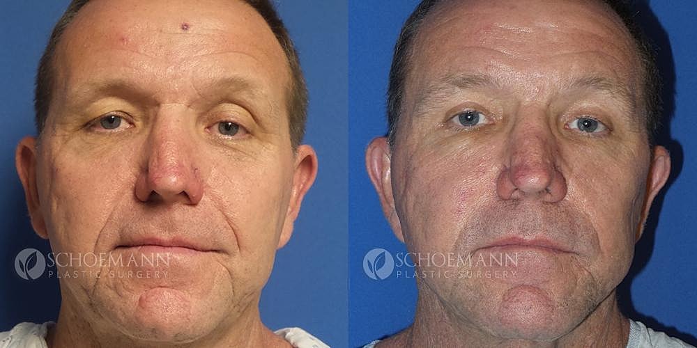 Facelift Before & After