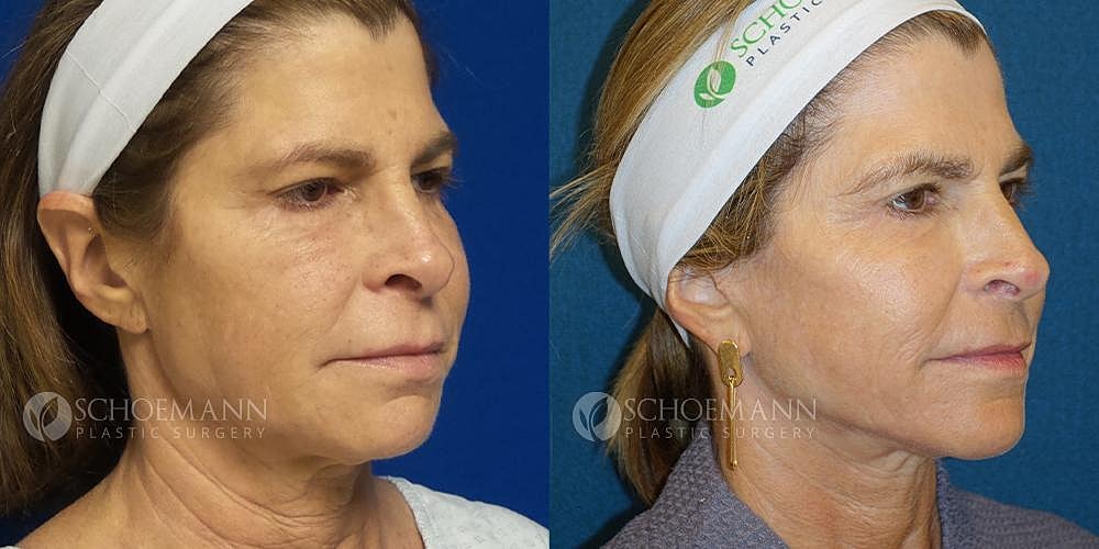 Facelift Before & After