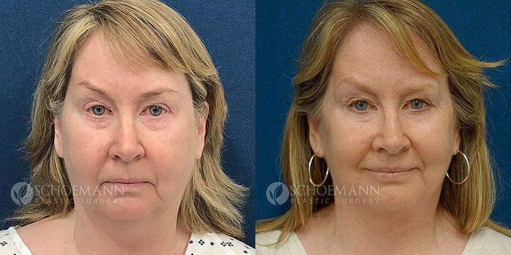Facelift Before & After