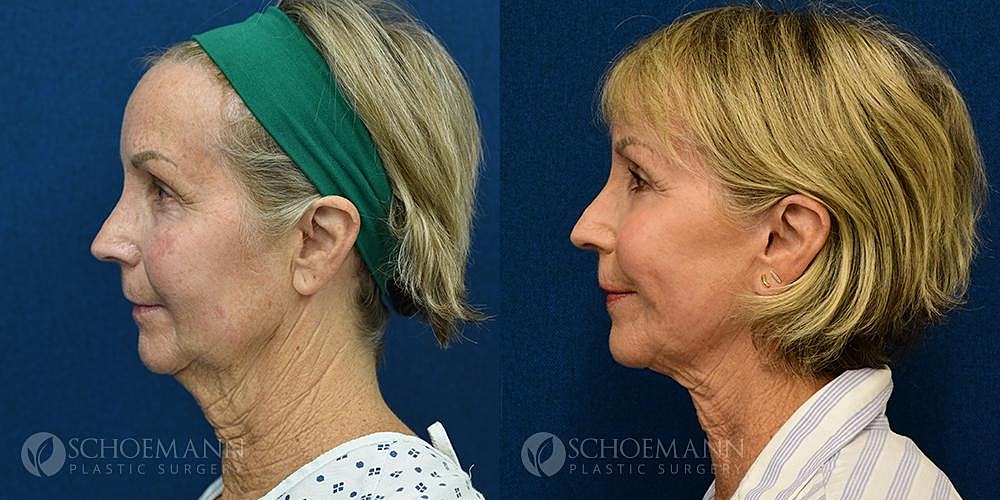 Facelift Before & After