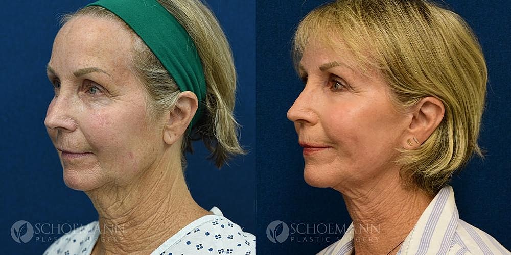 Facelift Before & After