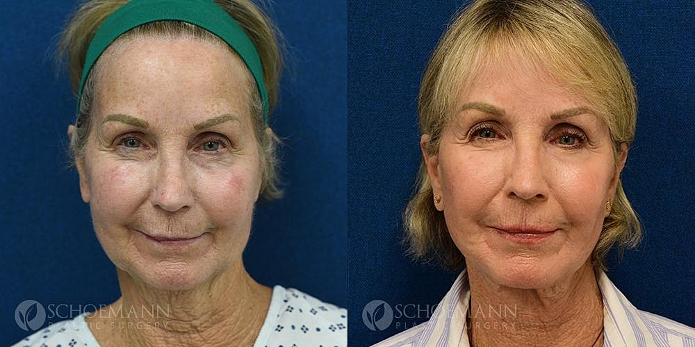 Facelift Before & After
