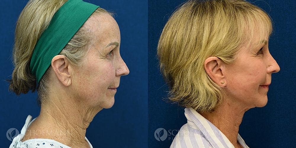 Facelift Before & After