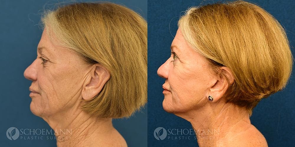 Facelift Before & After