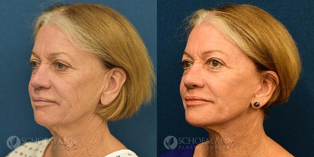 Facelift Before & After