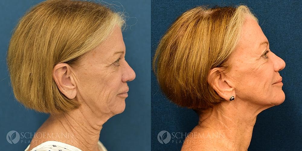 Facelift Before & After
